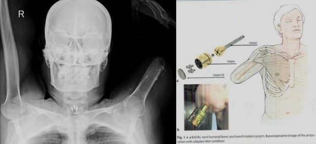 Έκτακτο: Βιονικό χέρι σε 45χρονο στην Κύπρο